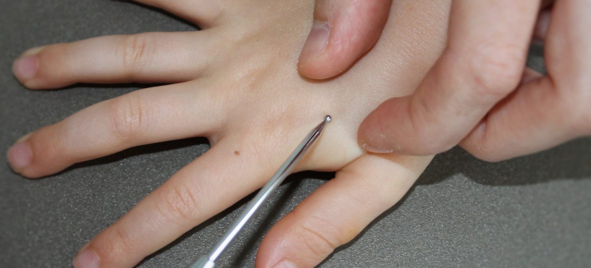 Wist u dat acupunctuur ook bijzonder geschikt is voor kinderen en baby’s?